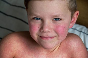 «П’ята хвороба» (парвовірус В19)