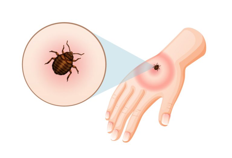 Хвороба Лайма