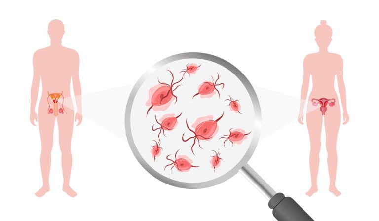 Трихомонада: виявити та вилікувати!